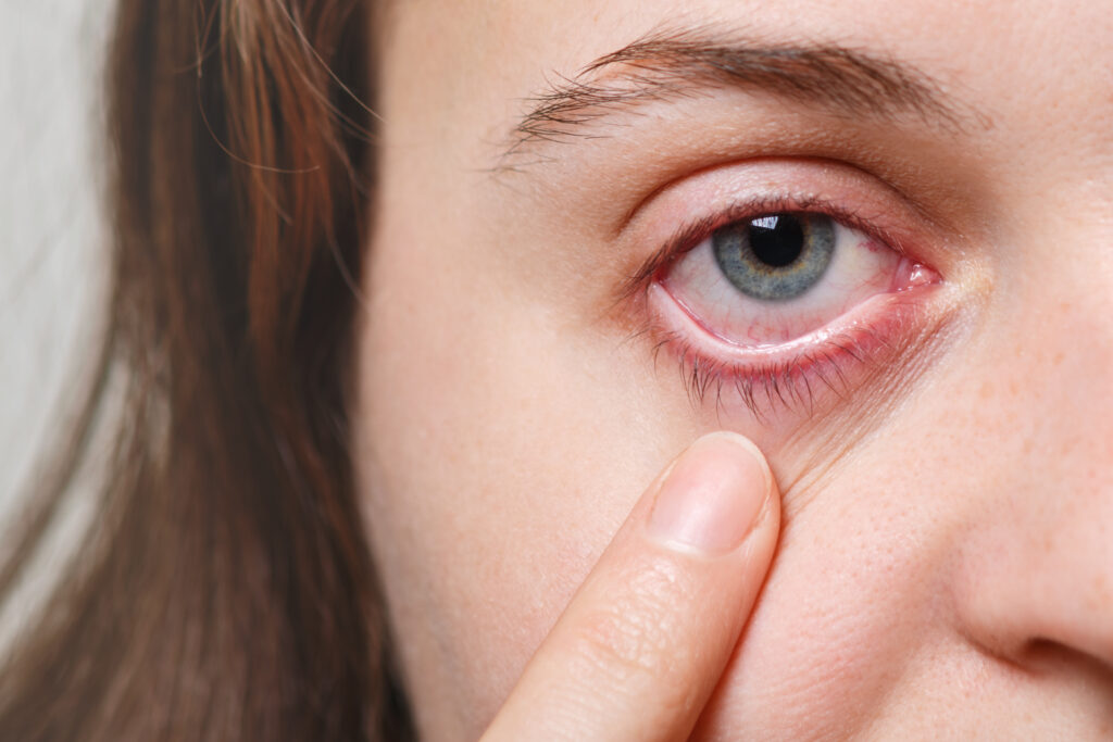 Olhos vermelhos: o que pode ser e o que fazer